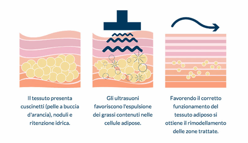 Effetti Cavitazione Estetica